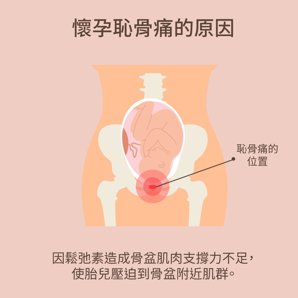 懷孕後期恥骨痛是快生了嗎 懷孕恥骨痛 托腹帶能解救 Mamaway